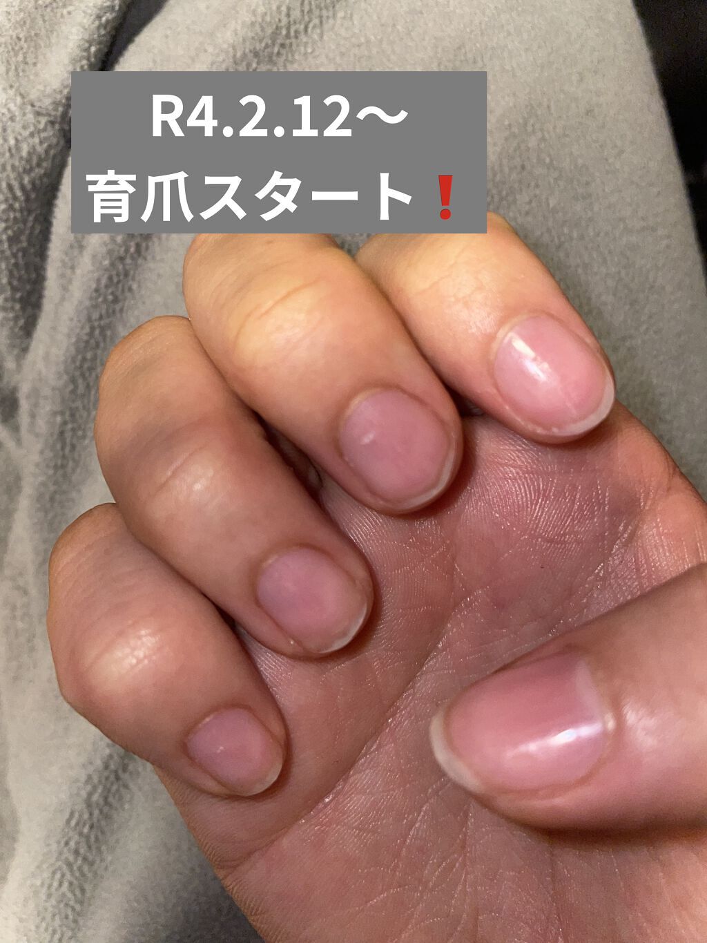 ビューティーチャージ アトリックスを使った口コミ 育爪開始 誰がどう見ても不健康で栄養がな By モモコ 乾燥肌 代前半 Lips ビューティーチャージ アトリックスを使った口コミ 育爪開始 誰がどう見ても不健康で栄養がな By モモコ 乾燥肌 代前半 Lips