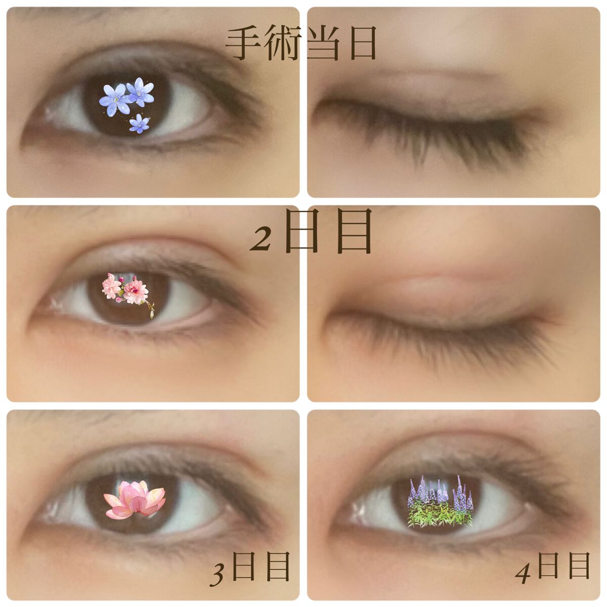 二重整形/その他を使ったクチコミ（2枚目）