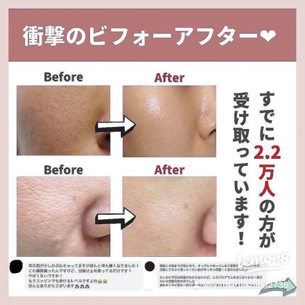 あなたの肌に合ったスキンケア💐コーくん先生 on LIPS 「【エグい位効く】毛穴の開きコレで一撃.
.
あなたの毛穴の開き..」(8枚目)