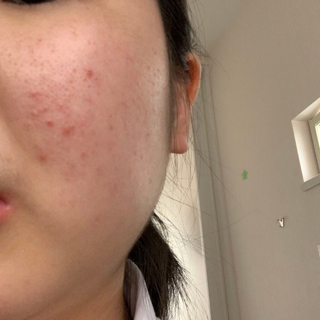 ちひろ on LIPS 「ニキビ日記ー8日目ーおはようございます😃昨日チョコを食べてしま..」(2枚目)