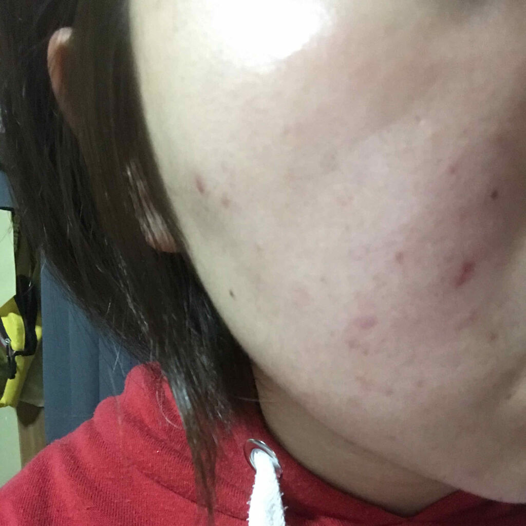 ペアアクネクリームW(医薬品)/ペア/その他を使ったクチコミ（1枚目）