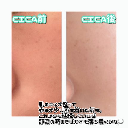 シカレチA エッセンス0.1/VT/美容液を使ったクチコミ(3枚目)