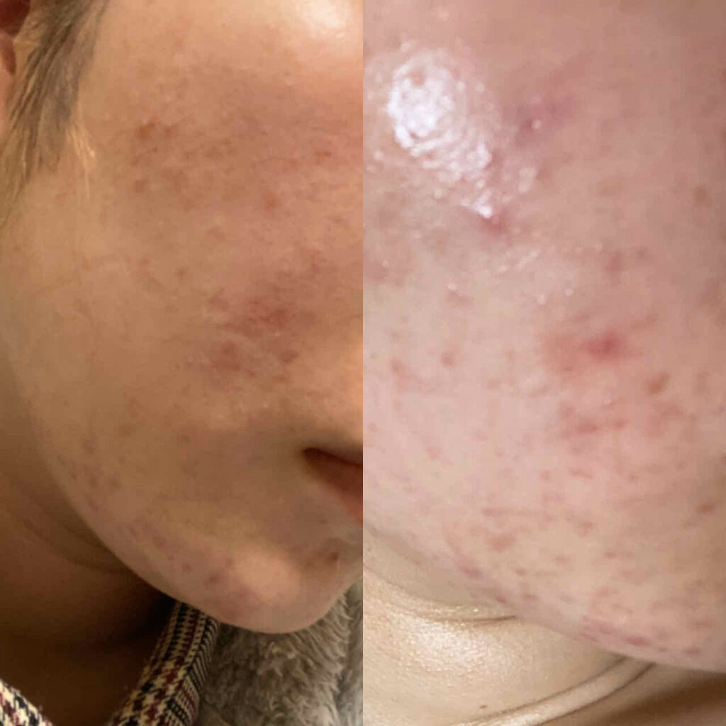 エピデュオゲル/マルホ株式会社/その他を使ったクチコミ（1枚目）