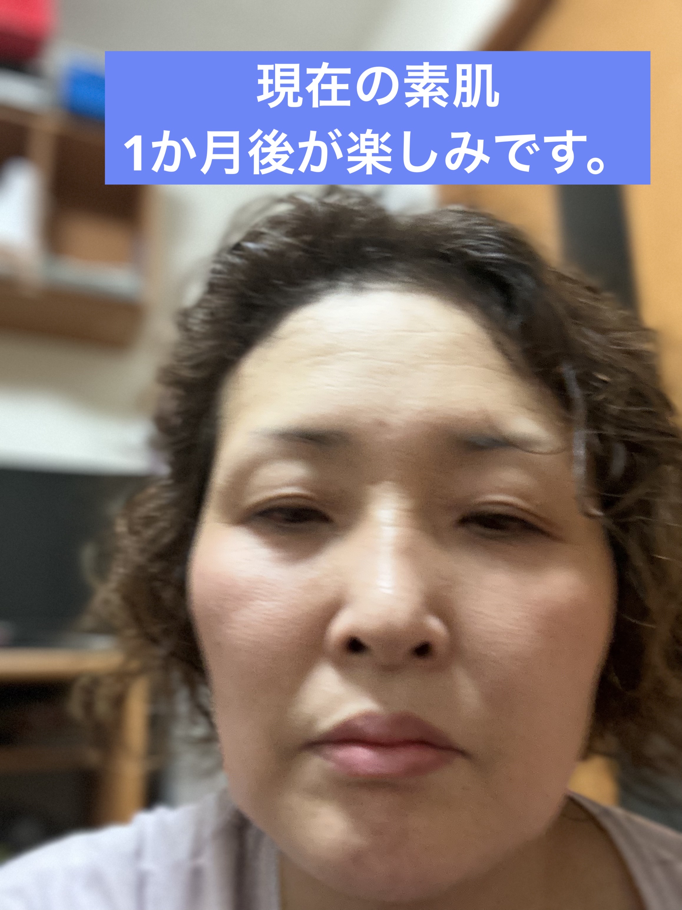 ハイドロキノン原液美容液/フィールドアンドデバイス/美容液を使ったクチコミ（3枚目）