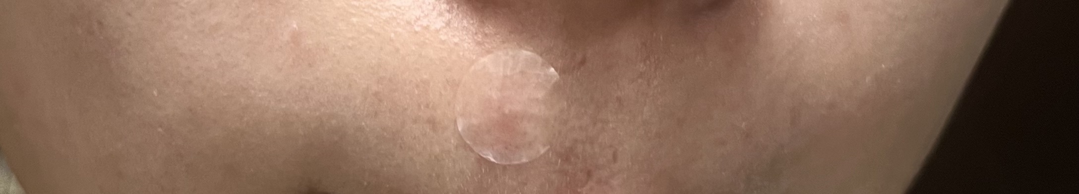 極薄透明パッチ nikipa!/金冠堂/にきびパッチを使ったクチコミ（3枚目）