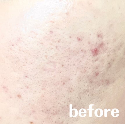 綴 on LIPS 「【肌断食で驚きの結果に!?】こんにちは、綴です🙌🏻つい最近コロ..」(2枚目)