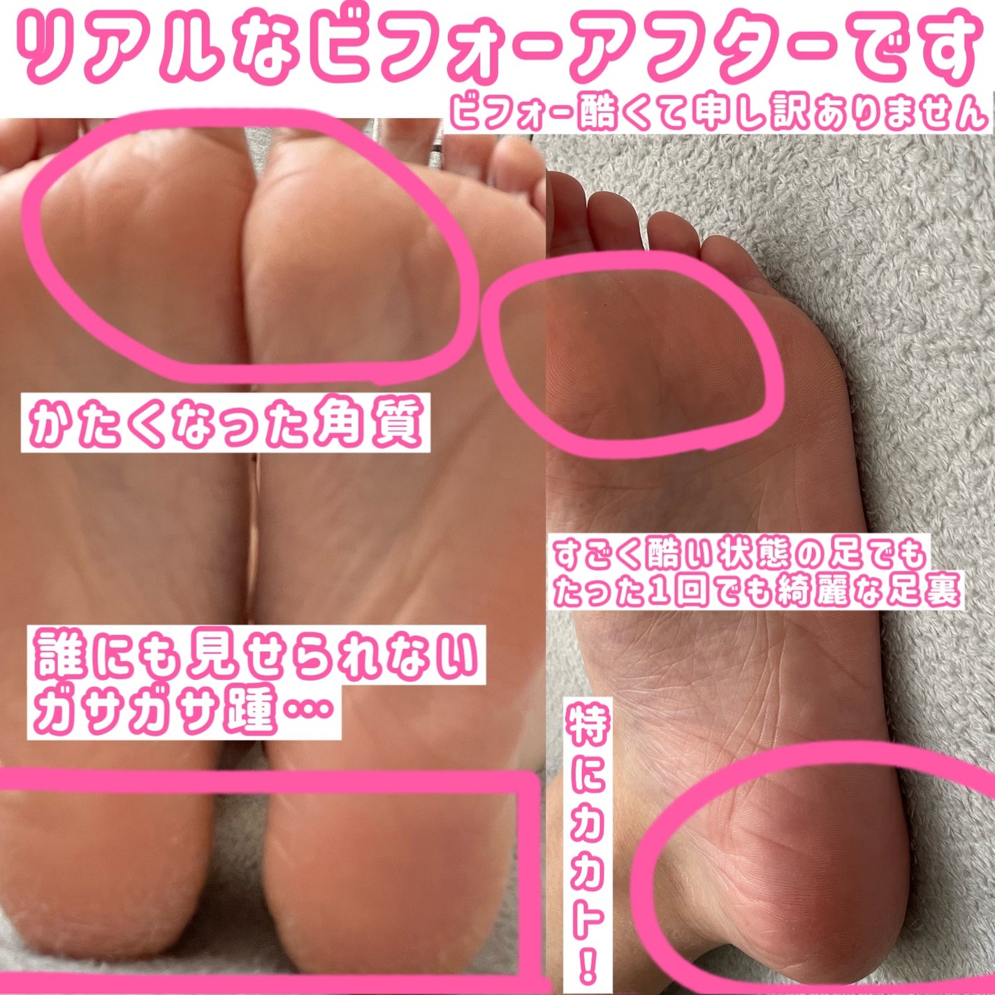 イージーパックDP60分タイプ/ベビーフット/レッグ・フットケアを使ったクチコミ(4枚目)