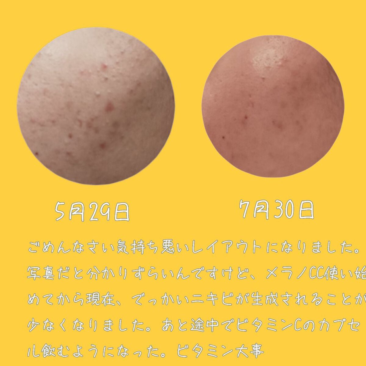 薬用 しみ 集中対策 美容液/メラノCC/美容液を使ったクチコミ(6枚目)