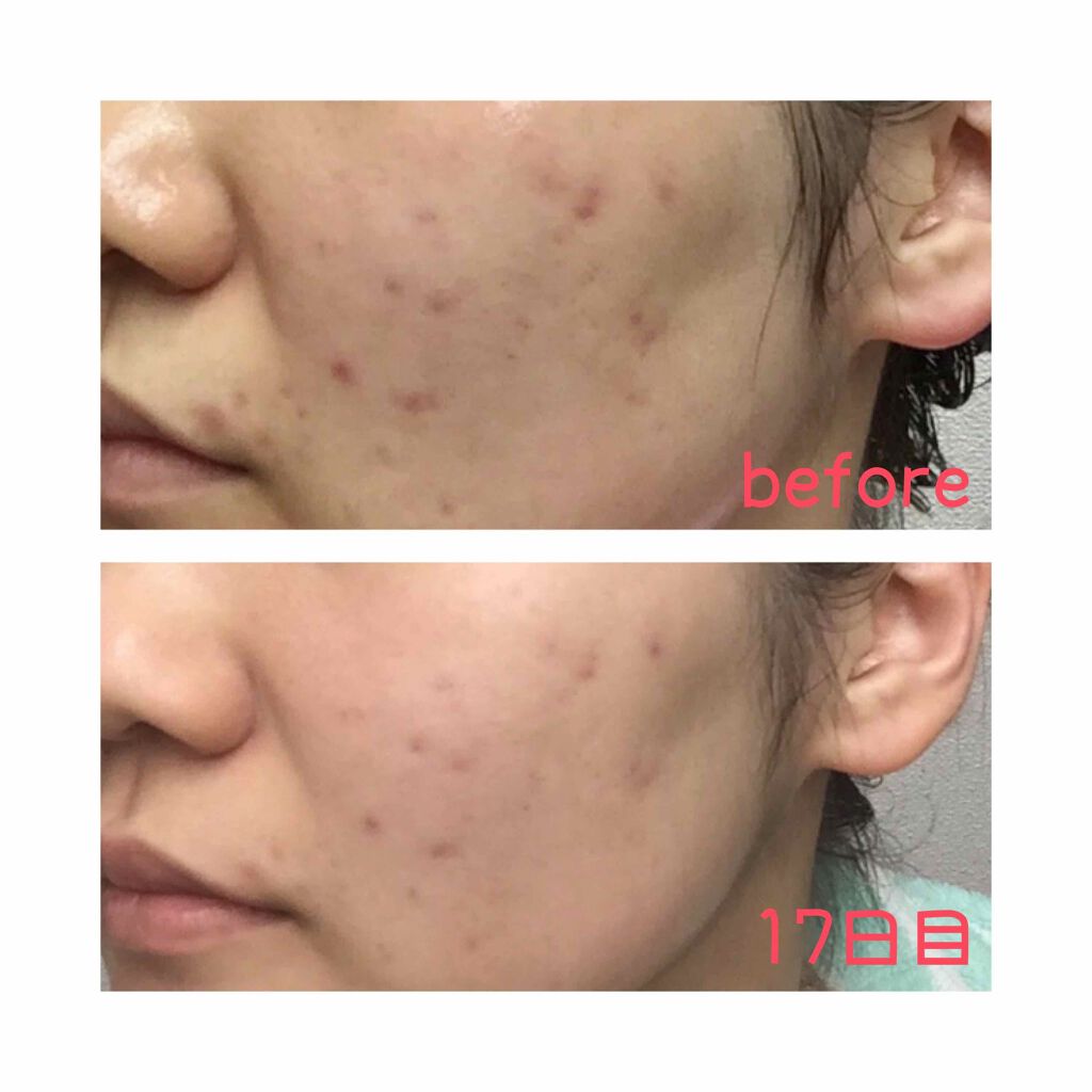 オールキルクリーム/APLIN/フェイスクリームを使ったクチコミ（3枚目）