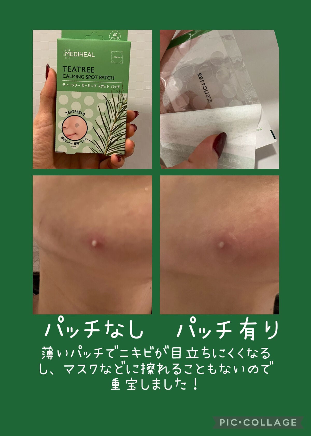 ティーツリーカーミングスポットパッチ/MEDIHEAL/その他スキンケアを使ったクチコミ(2枚目)