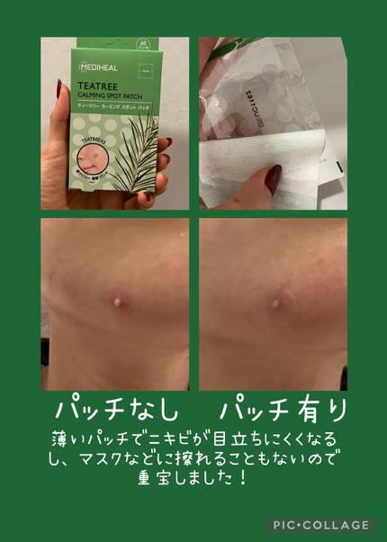 ティーツリーカーミングスポットパッチ/MEDIHEAL/その他スキンケアを使ったクチコミ(2枚目)