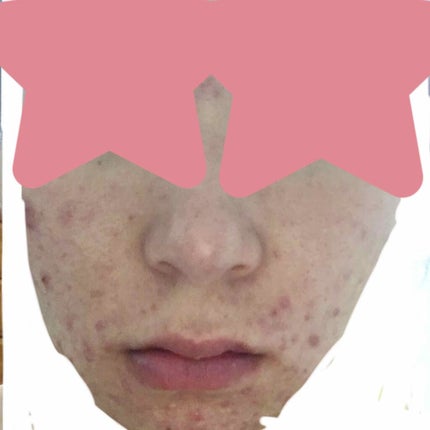 ベピオゲル/マルホ株式会社/その他を使ったクチコミ(2枚目)