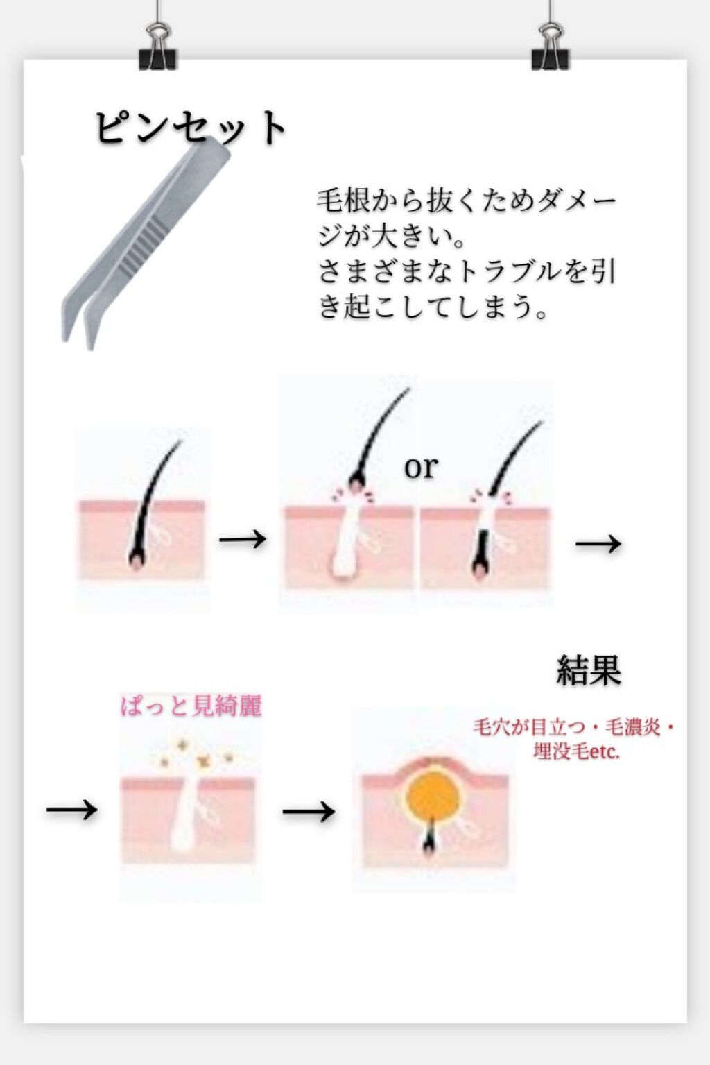 フェリエ フェイス用 Es Wf40 Panasonicを使った口コミ お久しぶりです 夏がすぐそこまでやってきま By 初心者 紅 敏感肌 10代後半 Lips