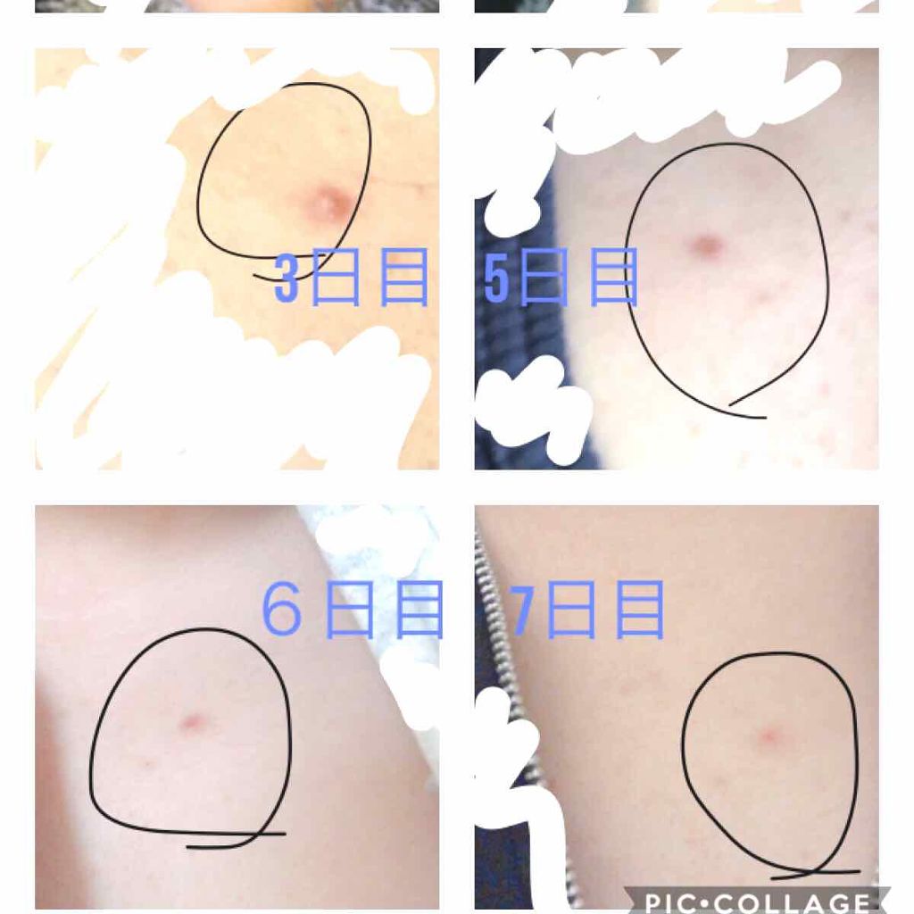 オロナインH軟膏 (医薬品)/オロナイン/その他を使ったクチコミ(3枚目)