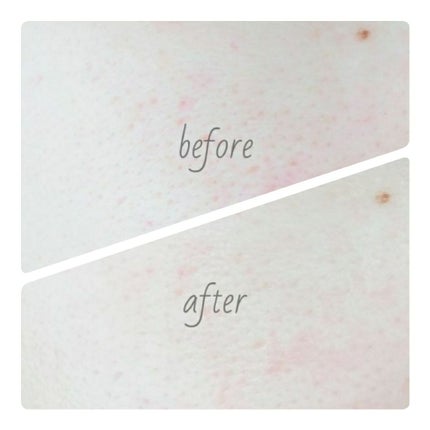 シナプス 炭酸革命 アクネのクチコミ「24時間テレビの勝利くんかっこよかったね笑
今まで特にセクゾのファンとかではなかったんですけど.....」(2枚目)