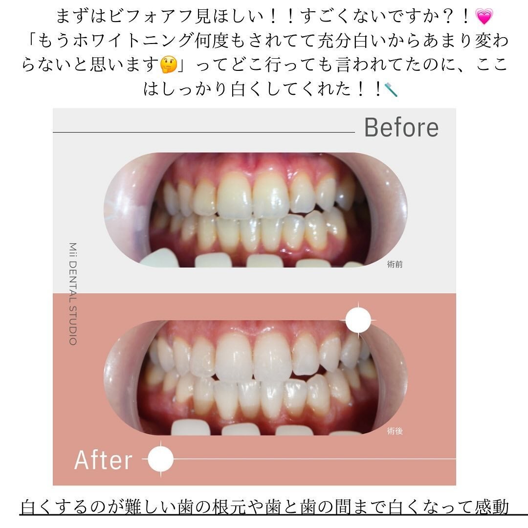 みりん on LIPS 「『歯は顔面にくっついてる宝石』だと思っている私🦷💎定期的なホワ..」(4枚目)