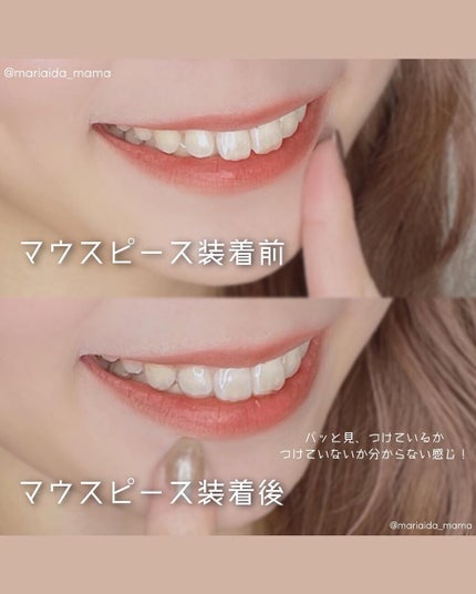 愛田まり(まりりん) on LIPS 「𓂃𓈒𓏸🗣マウスピースってどんな感じ❔アットスマイル矯正体験レポ..」(3枚目)
