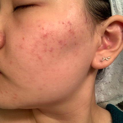 ティーツリーケア ソリューション エッセンシャルマスクEX/MEDIHEAL/シートマスク・パックを使ったクチコミ(3枚目)