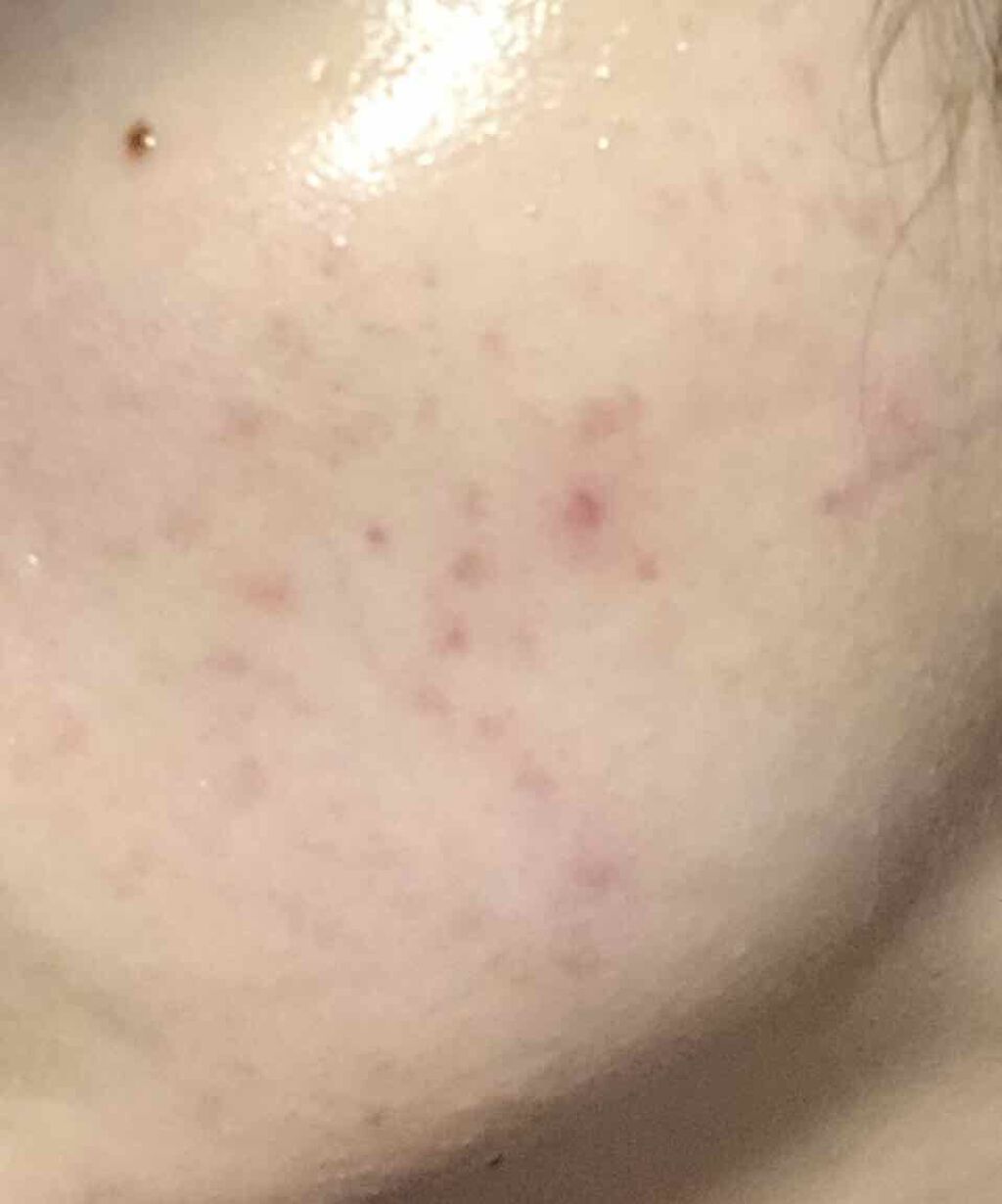 エリー⭐︎ 乾燥敏感肌 フォロバ100 on LIPS 「ニキビ経過おそらく生理からの大人ニキビが去年10月ぐらいからひ..」(4枚目)