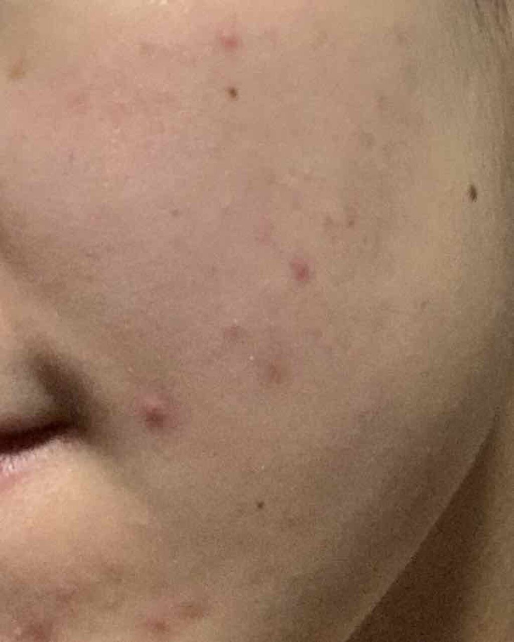 ミノン アミノモイスト 薬用アクネケア ローション/ミノン/化粧水を使ったクチコミ（3枚目）