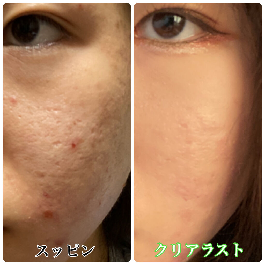 クリアラスト フェイスパウダー N 薬用オークル/クリアラスト/プレストパウダーを使ったクチコミ（3枚目）