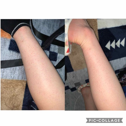 ケアノキュア(医薬品)/小林製薬/その他を使ったクチコミ(3枚目)