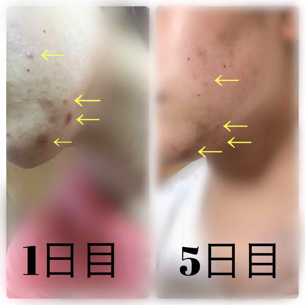 のんた on LIPS 「はじめまして!のんたです!ニキビ、出始めニキビ、ニキビ跡に効く..」(4枚目)