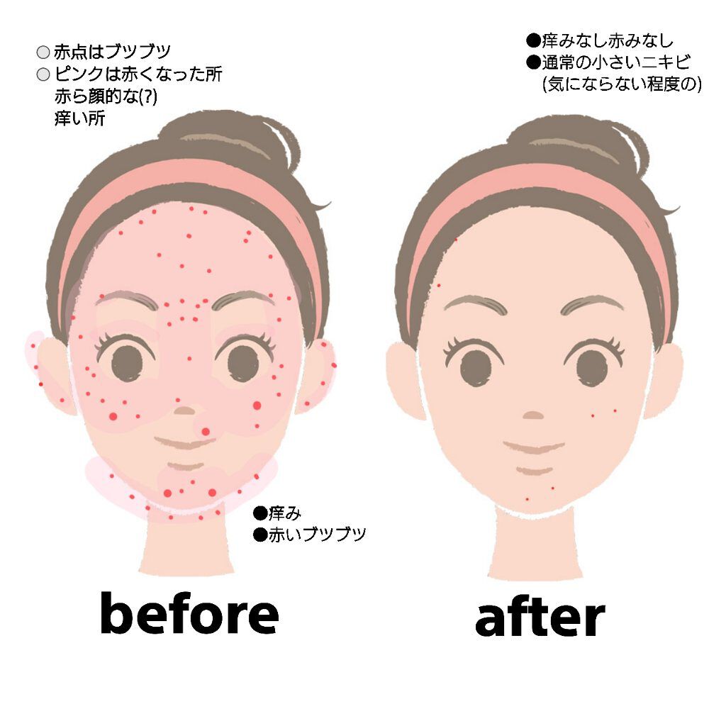 キュアレア（医薬品）/キュアレアa/その他を使ったクチコミ（2枚目）