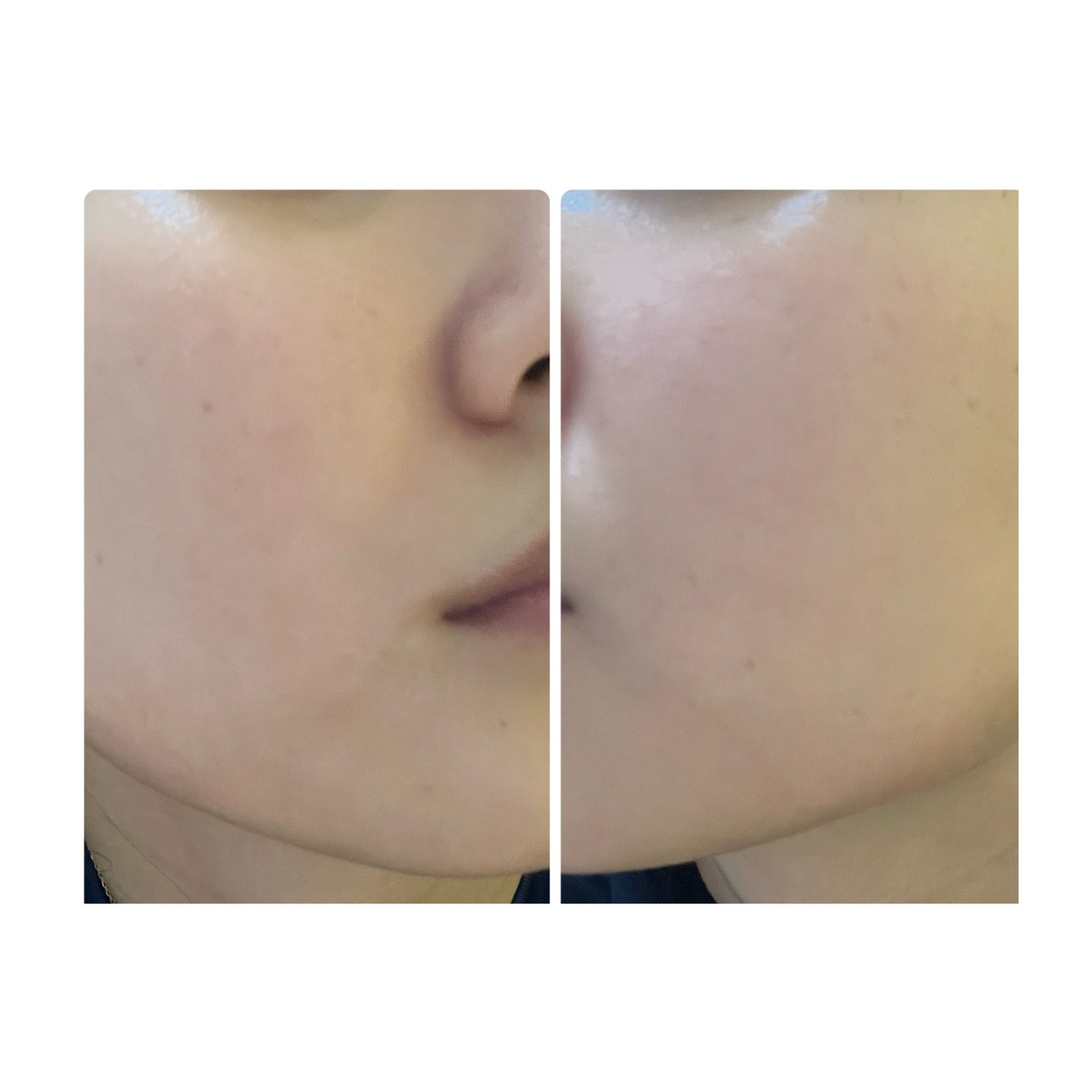 ぽむ on LIPS 「2023.9.13皮膚科に受診 エピデュオとヘパリン処方1枚目..」(1枚目)