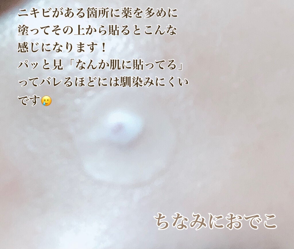 ポイントパッチ(集中ケアシート)/アクネスラボ/にきびパッチを使ったクチコミ(5枚目)