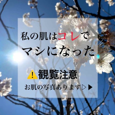 バイオイル バイオイルのクチコミ「まず初めに使い始める前は、白ニキビも赤いニキビもあるボッコボコの肌でした😂

まずちふれのコー.....」（1枚目）