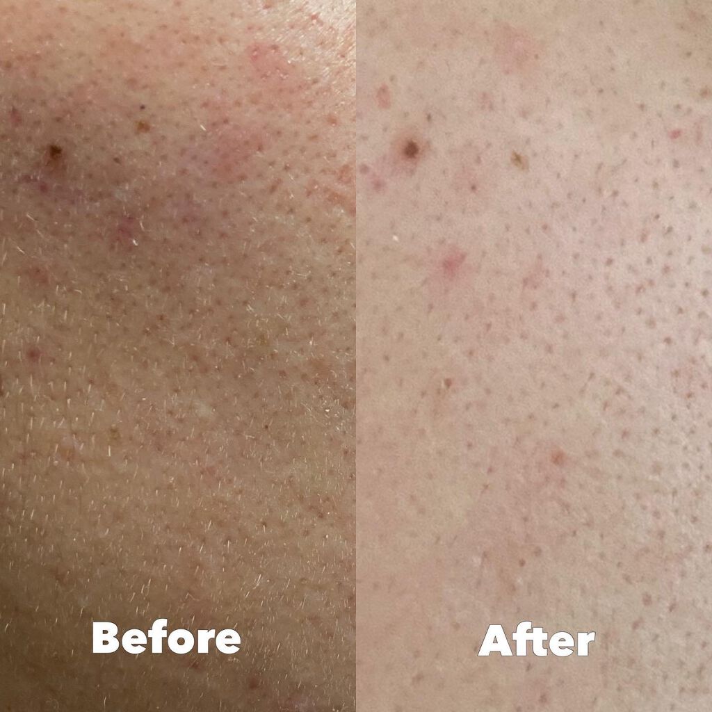 アドバンストエッセンスAZ/シェルシュール/美容液を使ったクチコミ(2枚目)