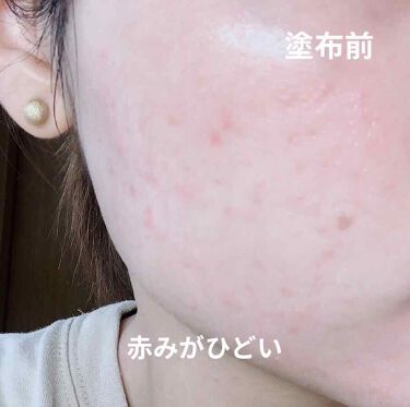 むぎちゃん On Lips 最近バイトや大学で毎日マスクをつけているので 頬を中心に肌荒れ Lips