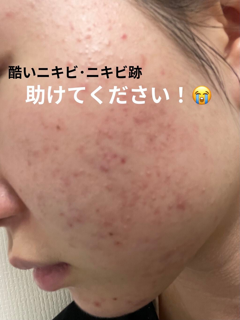 バイオイル/バイオイル/フェイスオイルを使ったクチコミ(1枚目)