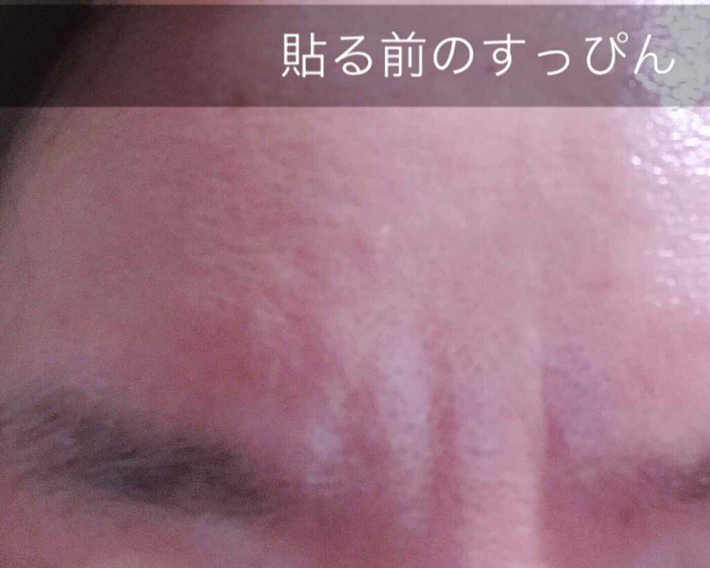 オデコディープパッチ/北の快適工房/シートマスク・パックを使ったクチコミ（2枚目）