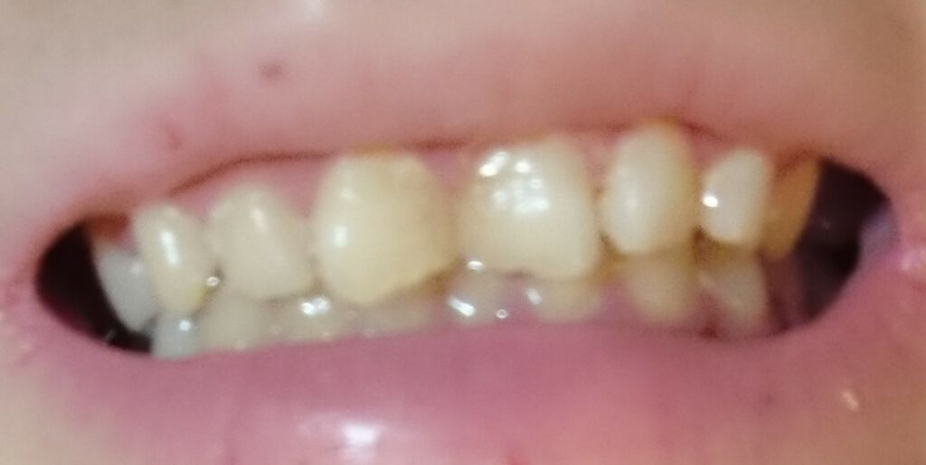 プレミアム ティースホワイトパック/Smile Cosmetique/その他オーラルケアを使ったクチコミ(3枚目)