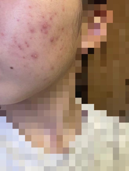 ニキビ治療薬(医薬品)/メンソレータム アクネス/その他を使ったクチコミ(3枚目)