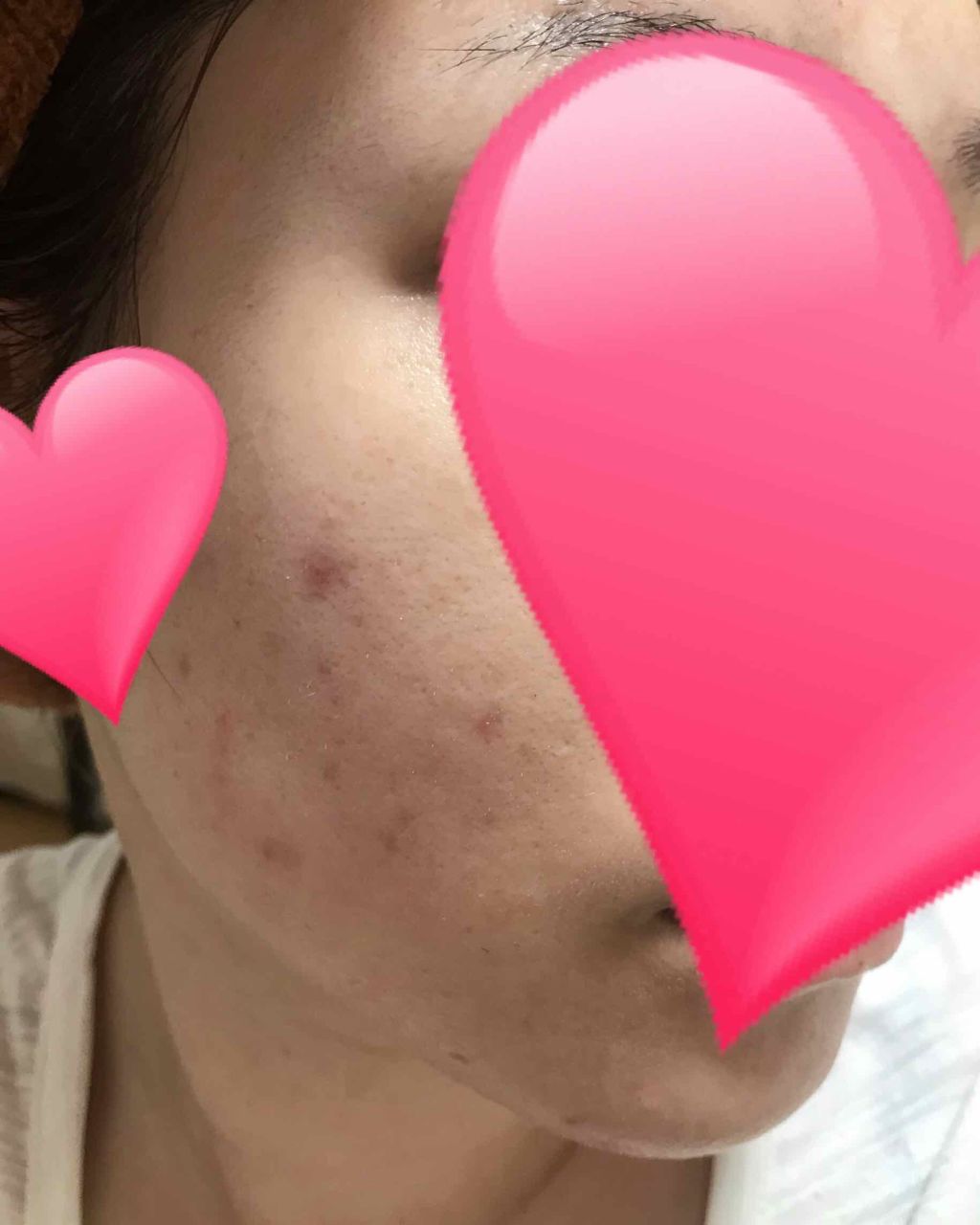 ハンガー on LIPS 「使用3日目カサつきが無くなってきました。痛みも痒みもだいぶマシ..」(2枚目)