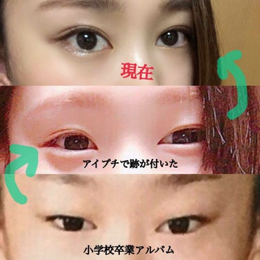 とろろこんぶ on LIPS 「施術名:フォーエバー二重術(湘南美容外科小倉院)切開はダウンタ..」（2枚目）