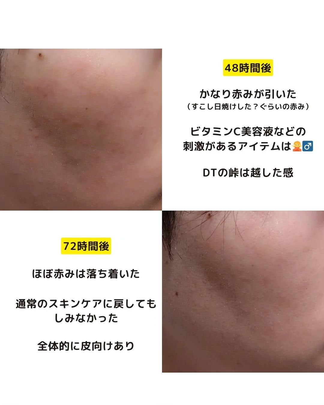 あき┃筋トレ美容家 on LIPS 「こんばんは、あきです!先日、人生2回目のダーマペンを受けてきま..」(5枚目)