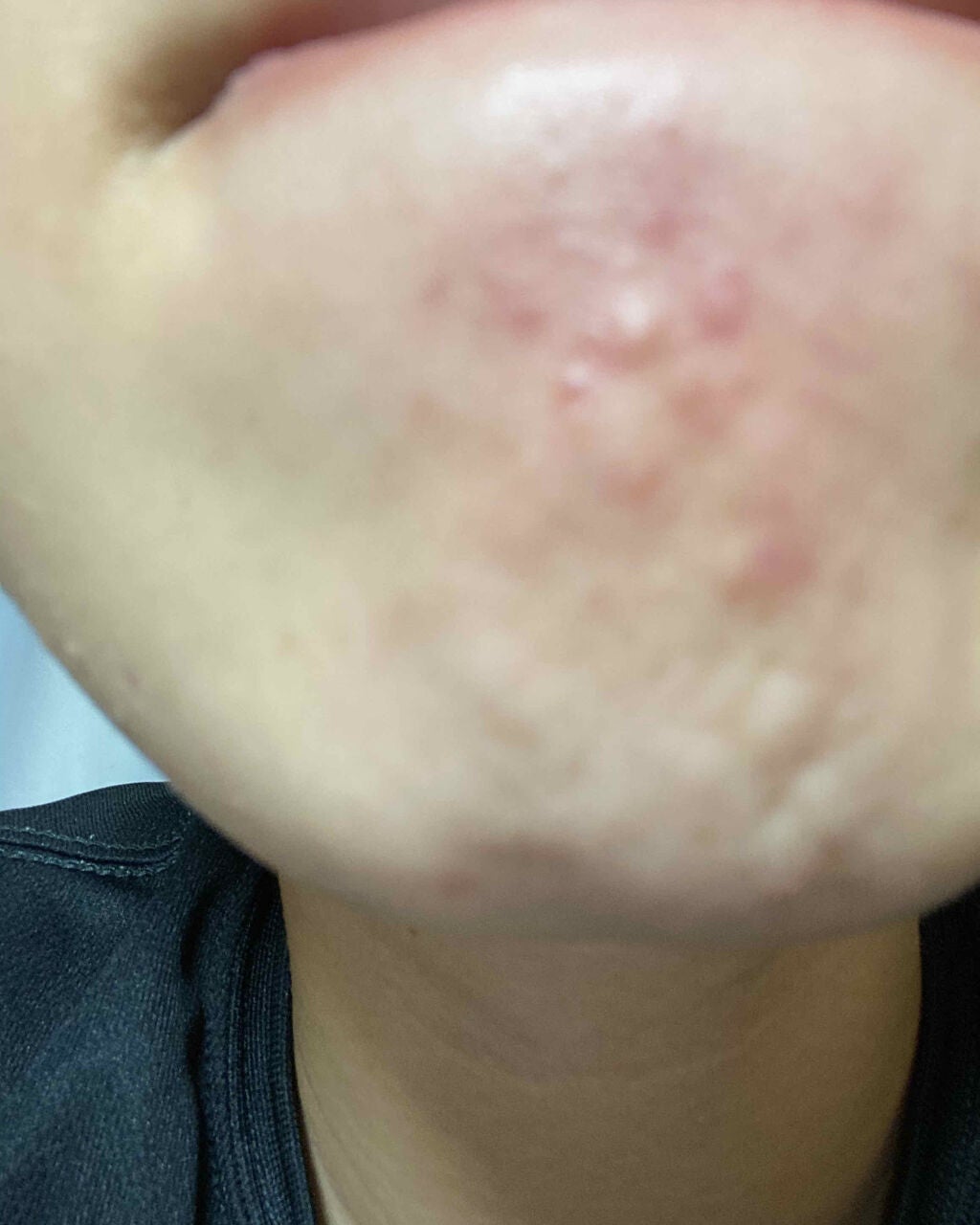 のの on LIPS 「閲覧注意です⚠️約3年間ニキビが治らないです。誰か治る方法を教..」(3枚目)