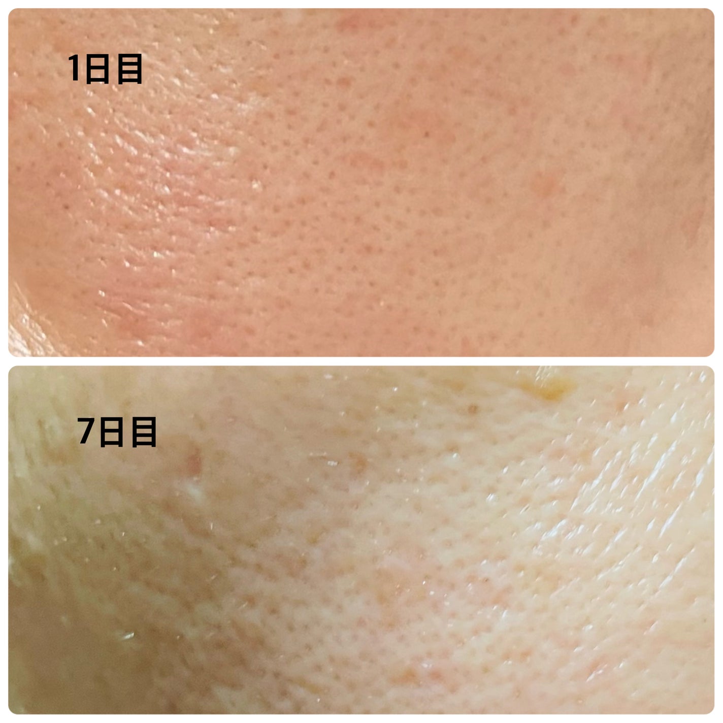 シカレチA エッセンス0.3/VT/美容液を使ったクチコミ(5枚目)