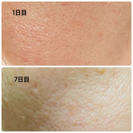 シカレチA エッセンス0.3/VT/美容液を使ったクチコミ(5枚目)