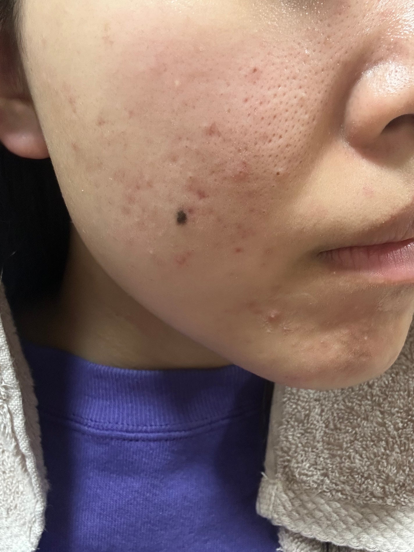 あ on LIPS 「ケミカルピーリング1回目終了好転反応なのか白ニキビ?がポツポツ..」(1枚目)