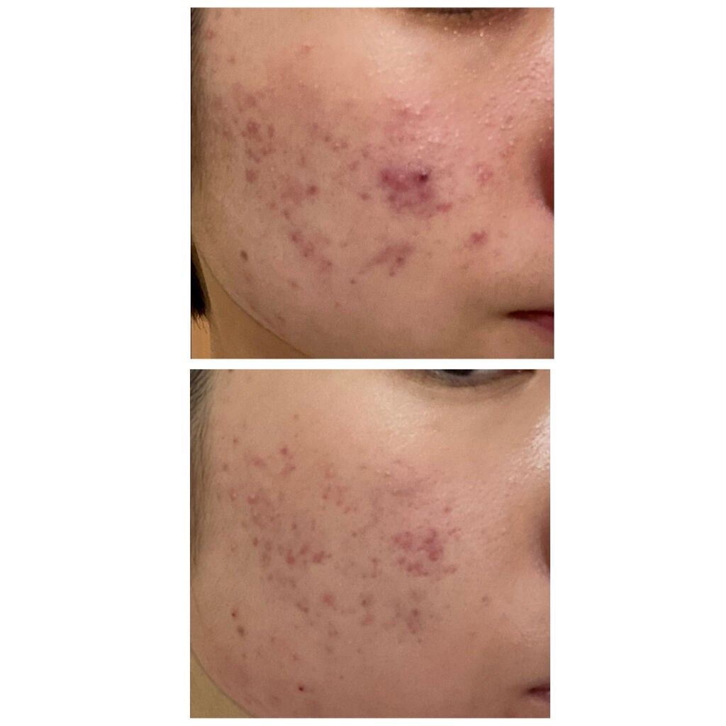 ロゼット洗顔パスタ アクネクリア/ロゼット/洗顔フォームを使ったクチコミ(2枚目)