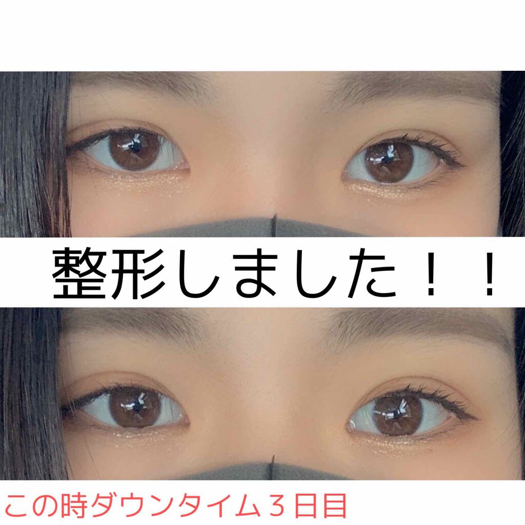 なおなお on LIPS 「二重整形してきました!!埋没して3日しかたってかいけど思ったよ..」(1枚目)