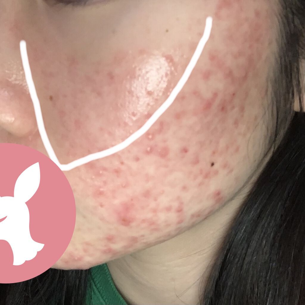 A アクネローション/NOV/化粧水を使ったクチコミ（2枚目）