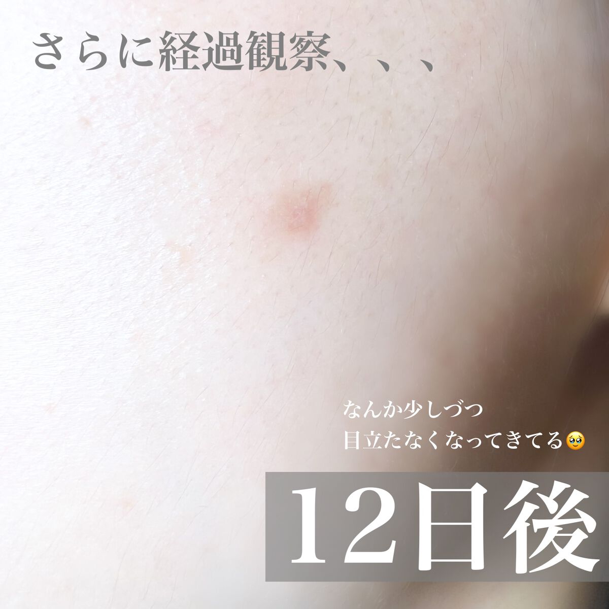 ディープビタCパッチ/MEDICUBE/その他スキンケアを使ったクチコミ(6枚目)