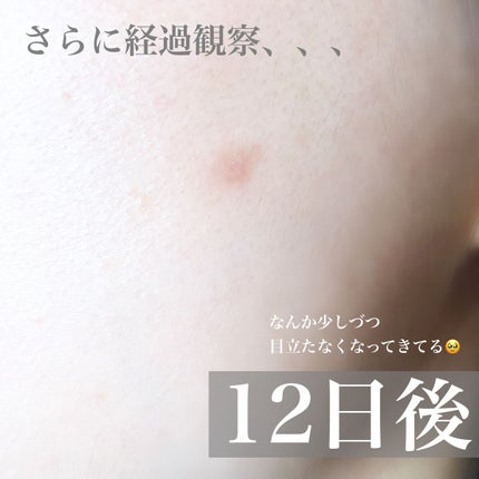 ディープビタCパッチ/MEDICUBE/その他スキンケアを使ったクチコミ(6枚目)