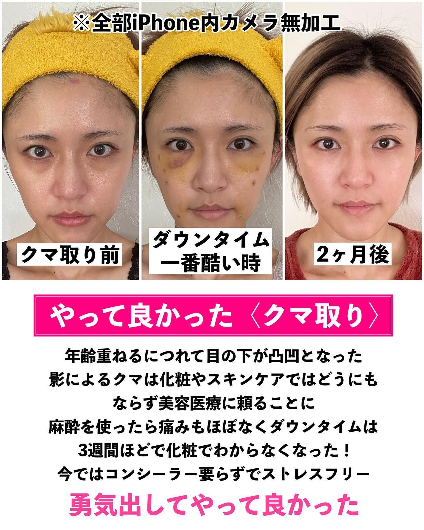 とみりー on LIPS 「36歳がやってよかった美容医療まとめ✨◆───--- - -..」(4枚目)